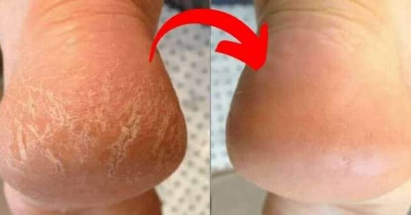 Adeus pés rachados com essa receita prática (Foto: Montagem) Adeus pés rachados com essa receita prática (Foto: Montagem)