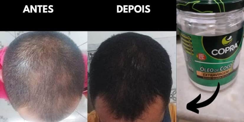 Calvície antes e depois da aplicação do óleo de coco (Foto Reprodução/Montagem/YouTube) Calvície antes e depois da aplicação do óleo de coco (Foto Reprodução/Montagem/YouTube)