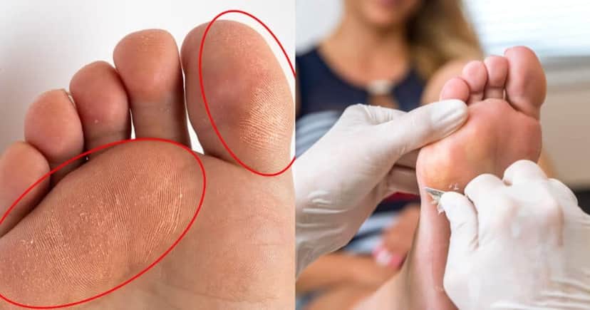 Adeus calos nos pés com essa receita (Foto: Montagem) Adeus calos nos pés com essa receita (Foto: Montagem)