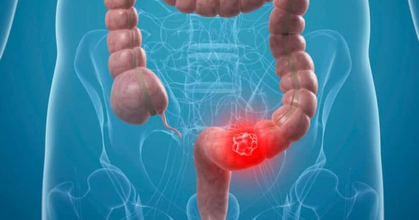 Cinco sinais de câncer de colon - Foto: Internet Cinco sinais de câncer de colon - Foto: Internet