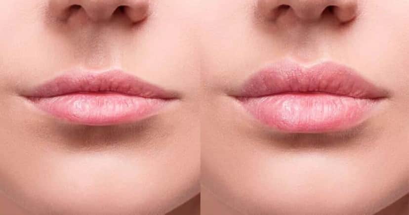 Receita natural com 2 ingredientes deixa lábios super volumosos (Reprodução/Dream Plastic/Canva)