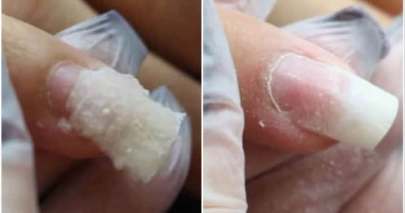 Unha reparada usando papel higiênico (Foto: Reprodução/ Internet)