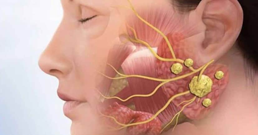 Câncer nas glândulas salivares - Foto: Internet Câncer nas glândulas salivares - Foto: Internet