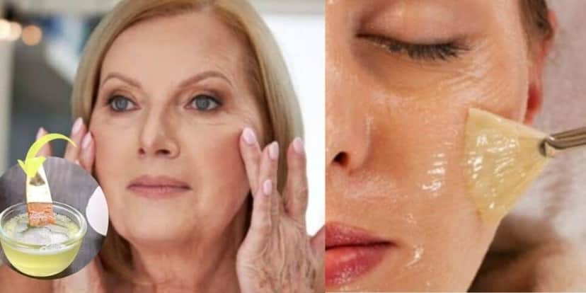 Lifting facial caseiro para rugas (Foto: Internet) Lifting facial caseiro para rugas (Foto: Internet)