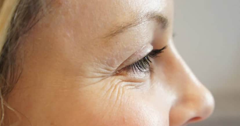 O fim dos terríveis pés de galinha, as rugas nos olhos (Foto: Divulgação) O fim dos terríveis pés de galinha, as rugas nos olhos (Foto: Divulgação)