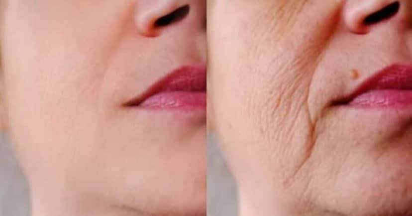 Mistura com 2 ingredientes populares preenchem rugas e deixam idosas 60+ com efeito de botox na pele - Foto: Internet Mistura com 2 ingredientes populares preenchem rugas e deixam idosas 60+ com efeito de botox na pele - Foto: Internet