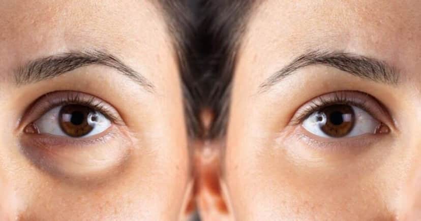 Mulher com e sem olheiras (Foto: Freepik) Mulher com e sem olheiras (Foto: Freepik)