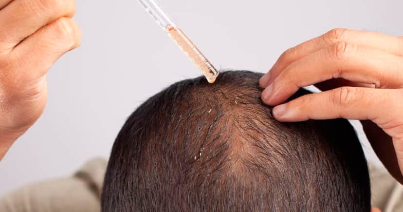 Anvisa - Uso de minoxidil (Foto: Reprodução) Anvisa - Uso de minoxidil (Foto: Reprodução)