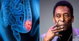 Diarreia, cansaço e mais: 6 sintomas silenciosos que indicam câncer no cólon como o de Pelé
