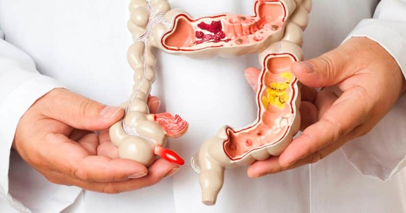 Sintomas de câncer no intestino (Foto: Reprodução) Sintomas de câncer no intestino (Foto: Reprodução)