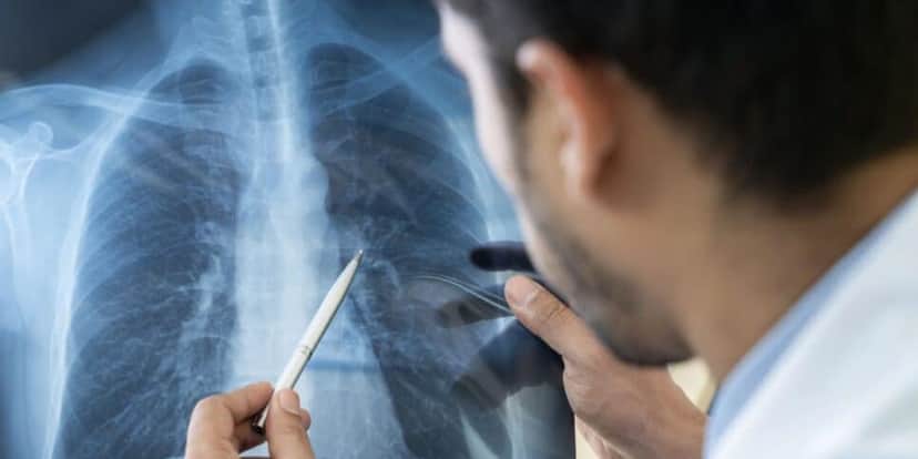 Tome cuidado com a pneumonia silenciosa (Reprodução: Internet) Tome cuidado com a pneumonia silenciosa (Reprodução: Internet)