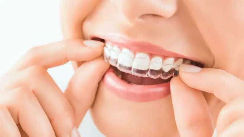 Tratamento com Invisalign (Foto: Reprodução/ Internet) Tratamento com Invisalign (Foto: Reprodução/ Internet)