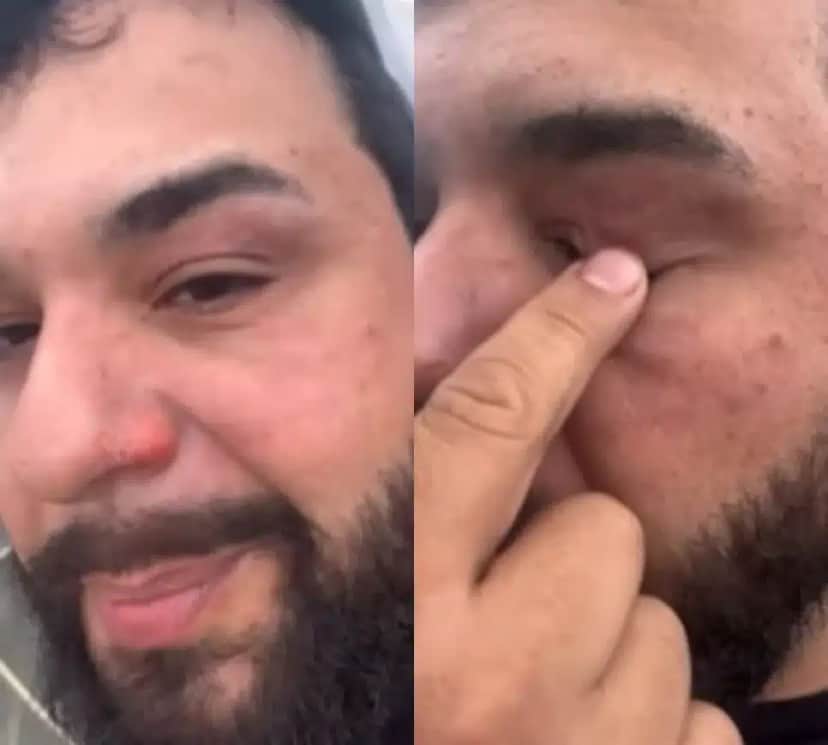 Músico sertanejo mostra como ficou o seu rosto após ser atingido pelo fogo (Foto: Reprodução/Montagem TV Foco) Músico sertanejo mostra como ficou o seu rosto após ser atingido pelo fogo (Foto: Reprodução/Montagem TV Foco)