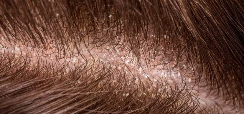 Cabelo com caspas (Foto: Divulgação) Cabelo com caspas (Foto: Divulgação)