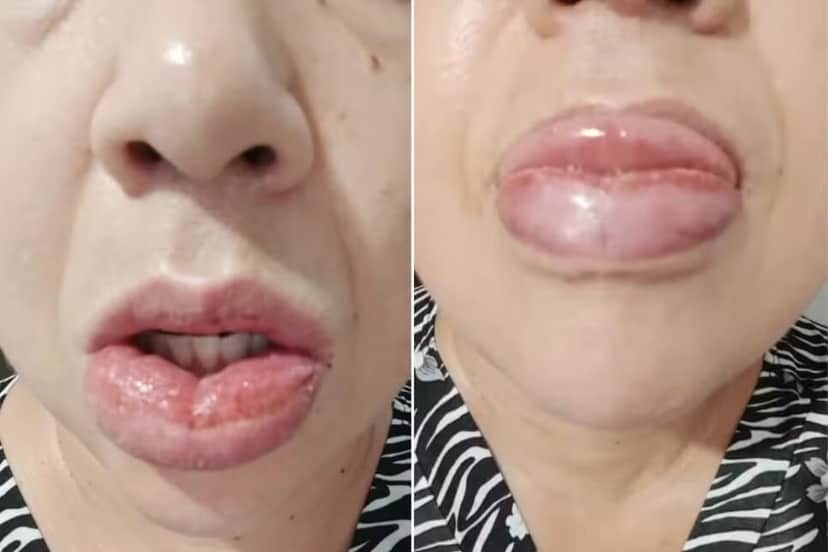 Situação dos lábios de uma usuária do creme dental Colgate Total Clean Mint (Foto Reprodução/G1) Situação dos lábios de uma usuária do creme dental Colgate Total Clean Mint (Foto Reprodução/G1)
