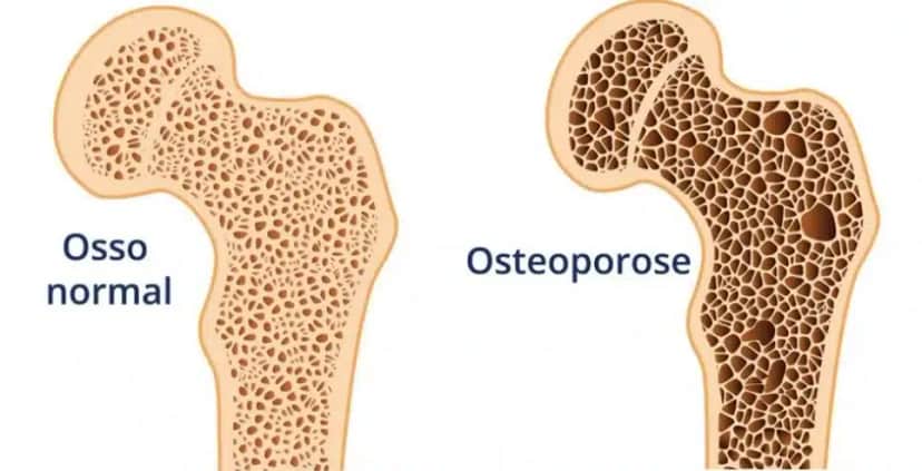 Sintomas da osteoporose (Foto: Reprodução/ Internet) Sintomas da osteoporose (Foto: Reprodução/ Internet)