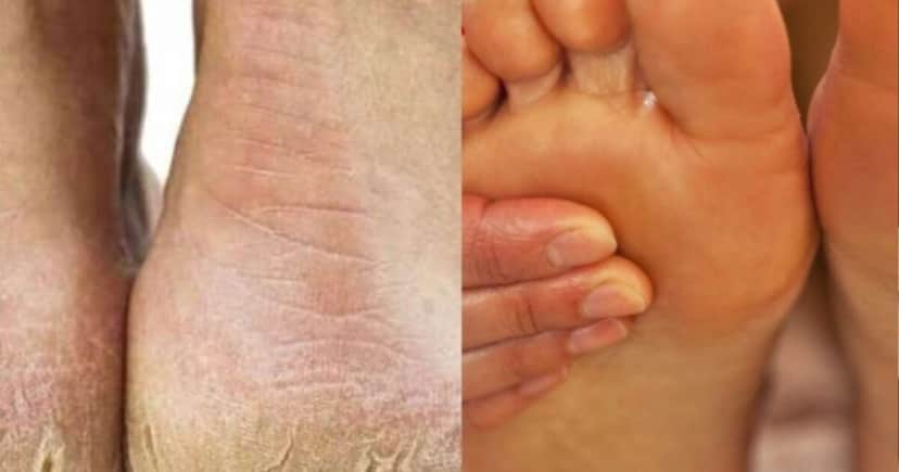 Receita para acabar com pés rachados - Foto: Montagem Receita para acabar com pés rachados - Foto: Montagem