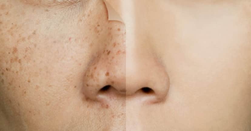 Veja como eliminar manchas da pele (Foto: Divulgação) Veja como eliminar manchas da pele (Foto: Divulgação)