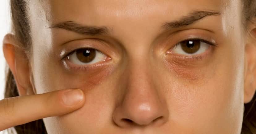 Como tratar olheiras (Foto: Divulgação) Como tratar olheiras (Foto: Divulgação)
