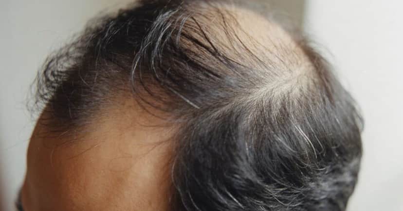 Cabelo com falhas (Foto: Canva) Cabelo com falhas (Foto: Canva)