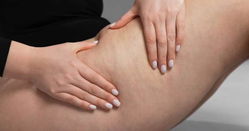 Mulher com celulite (Foto: Canva) Mulher com celulite (Foto: Canva)