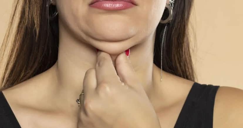 Como eliminar papada (Foto: Divulgação) Como eliminar papada (Foto: Divulgação)