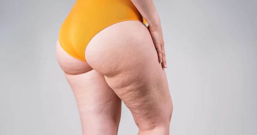 Como amenizar a celulite com essa dica (Foto: Divulgação) Como amenizar a celulite com essa dica (Foto: Divulgação)