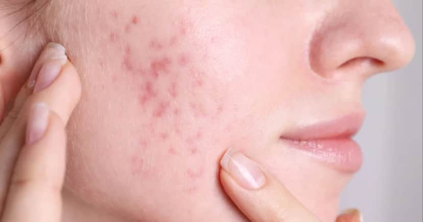 Manchas de acne (Foto: Reprodução/Internet) Manchas de acne (Foto: Reprodução/Internet)