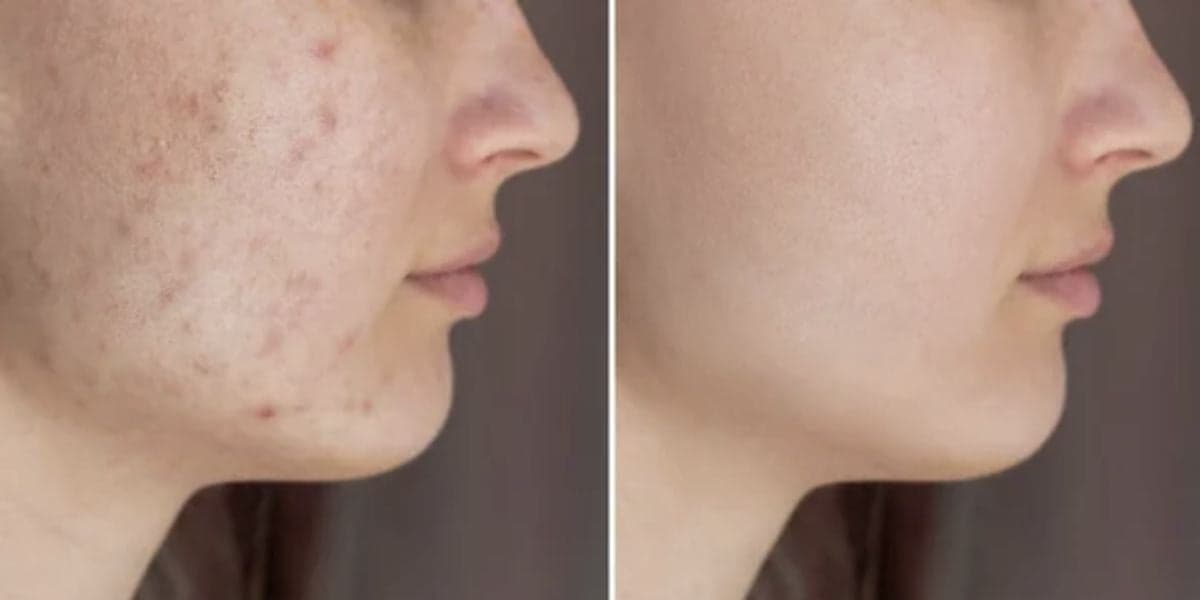 Antes e depois de manchas (Foto: Reprodução / Internet) Antes e depois de manchas (Foto: Reprodução / Internet)