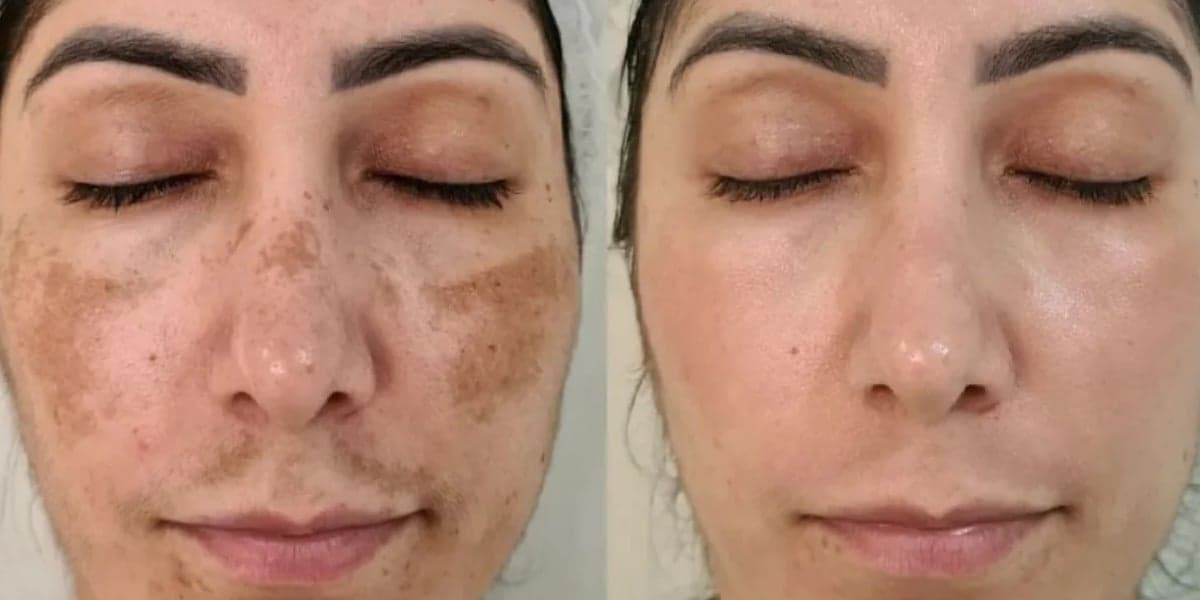 Manchas e rugas na pele (Foto: Reprodução, Beauty Face Brasil) Manchas e rugas na pele (Foto: Reprodução, Beauty Face Brasil)