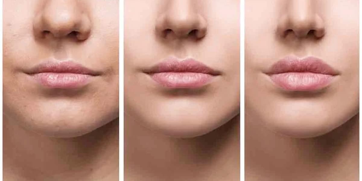 Lábios após Preenchimento labial (Foto: Reprodução, Clínica Carreirão) Lábios após Preenchimento labial (Foto: Reprodução, Clínica Carreirão)