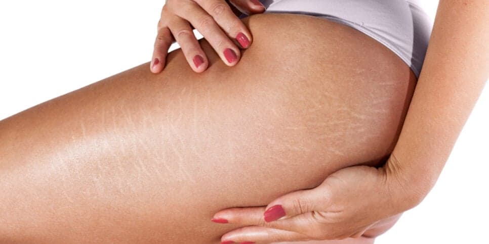 Estrias incomodam muitas mulheres (Foto: Divulgação) Estrias incomodam muitas mulheres (Foto: Divulgação)