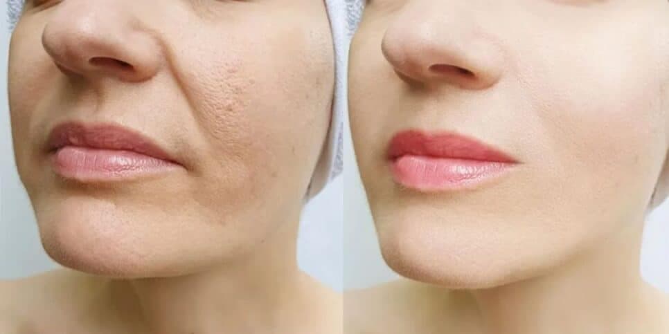Elixir da juventude: Óleo natural traz pele de bebê eliminando manchas e rugas do rosto das 50+
