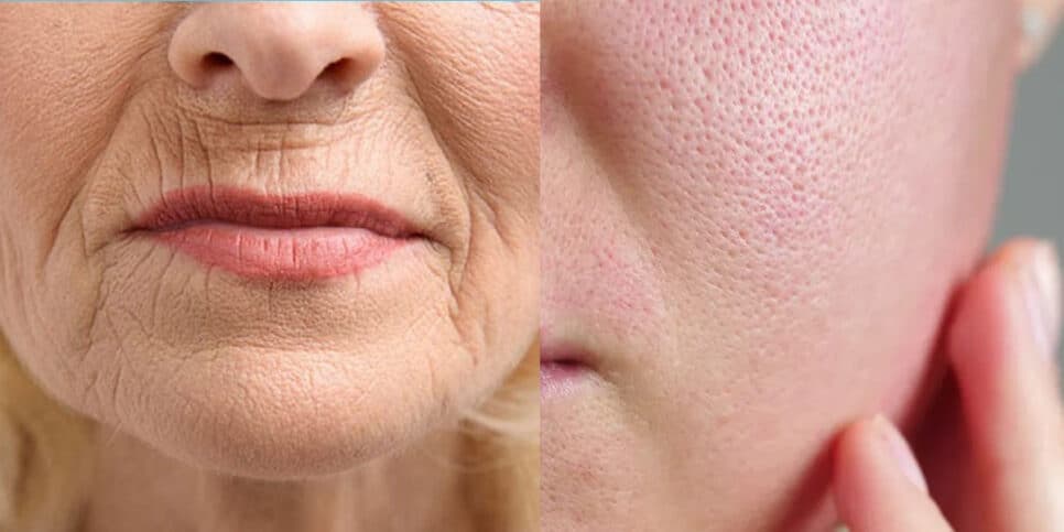 Fim das rugas e poros dilatados: Botox natural com chá indo direto no rosto deixa as 50+ com pele de seda 