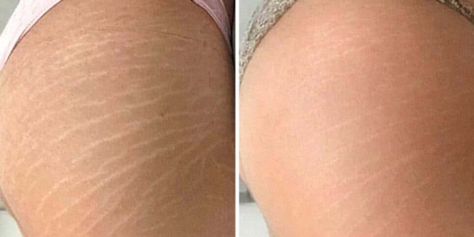 Tchau, estrias: Único ingrediente popular acaba com manchas das 50+ e traz melhor colágeno do mundo