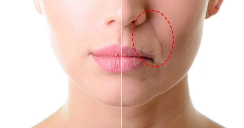 Graças a essa receita você vai se livrar do bigode chinês e das rugas  (Foto: Montagem)