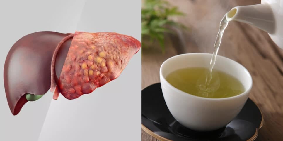 Suga a gordura do fígado: Chá milagroso com 2 ingredientes populares dá fim ao pesadelo das 60+