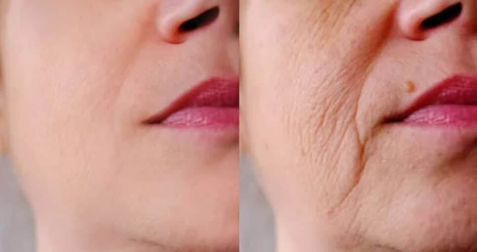 Botox com apenas 3 ingredientes caseiros coloca fim à flacidez e as rugas no rosto das 60+