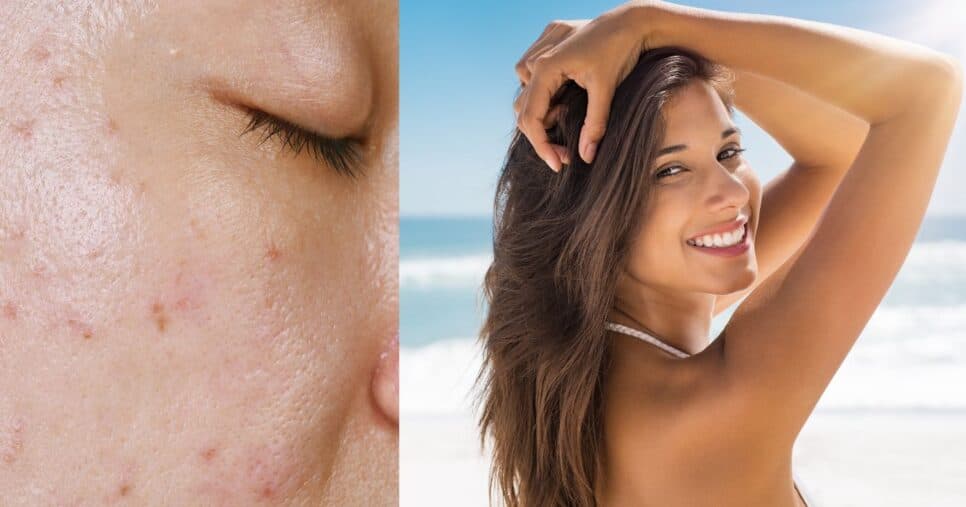 Fim das manchas e oleosidade: 5 passos infalíveis para evitar os danos do sol na pele e arrasar no Verão 2025