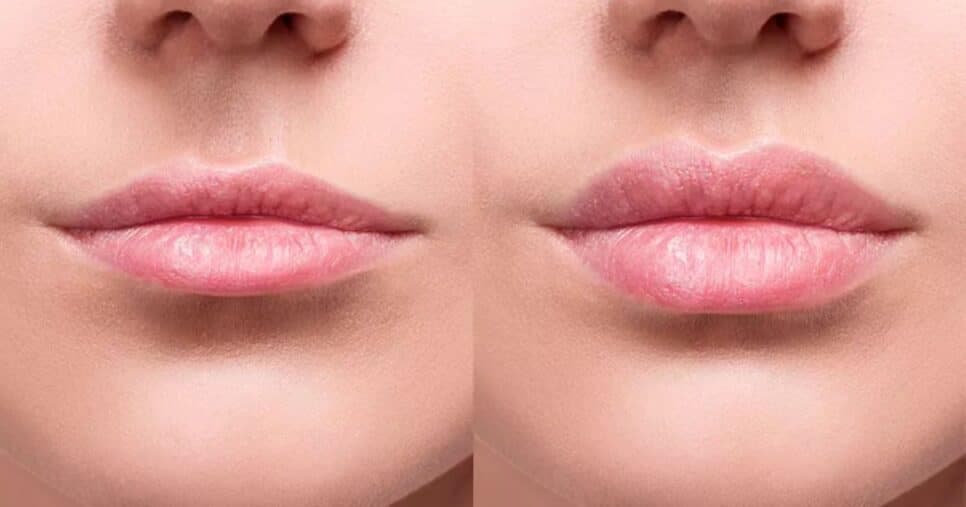 Boca grossa sem preenchimento: Receita natural com 2 ingredientes deixa lábios super volumosos