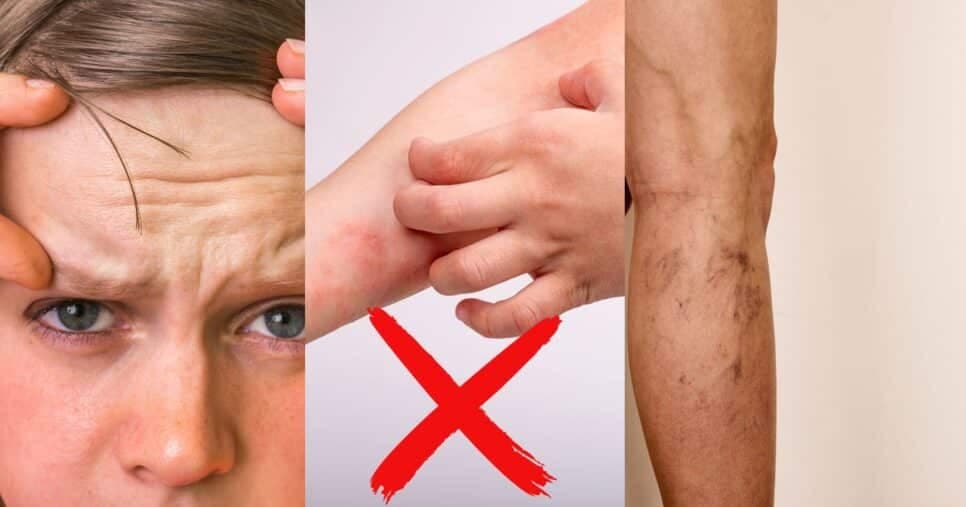 Óleo de coco, chá e mel: 3 receitas naturais acabam com varizes, dermatite e rugas das idosas 65+