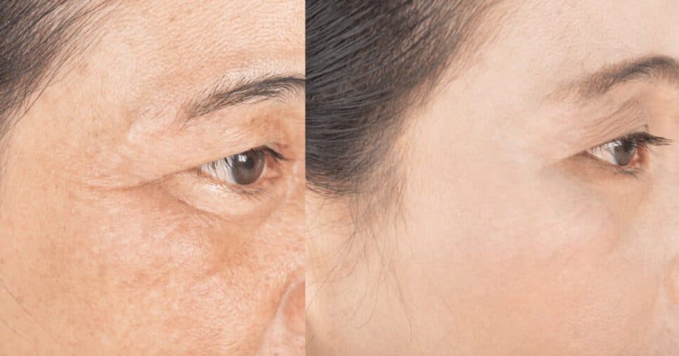 Pele firme, jovem e radiante: Remova rugas do rosto e paralise o envelhecimento usando 4 ingredientes