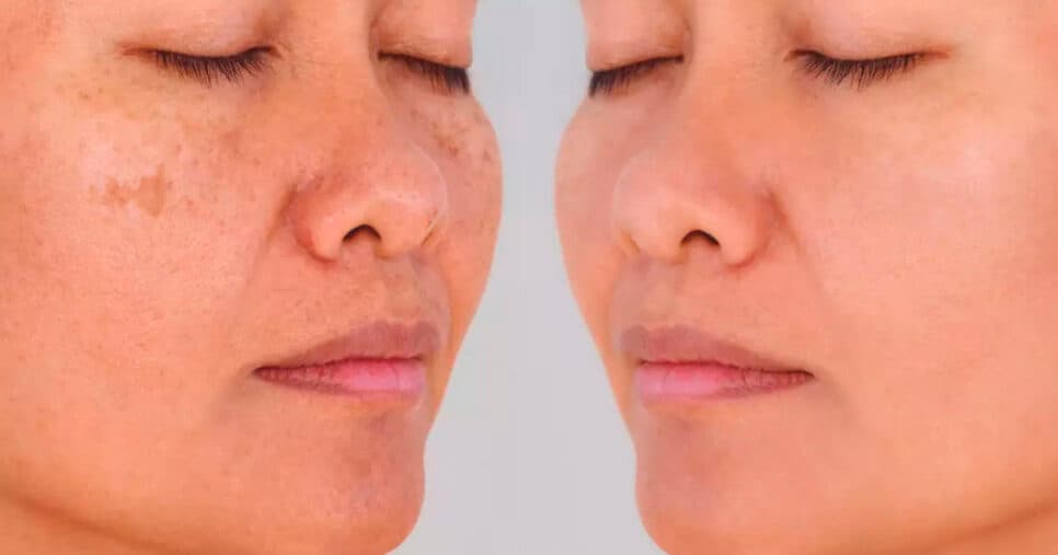 Adeus manchas do rosto: Receita fácil de 3 ingredientes caseiros produz o próprio colágeno e rejuvenesce