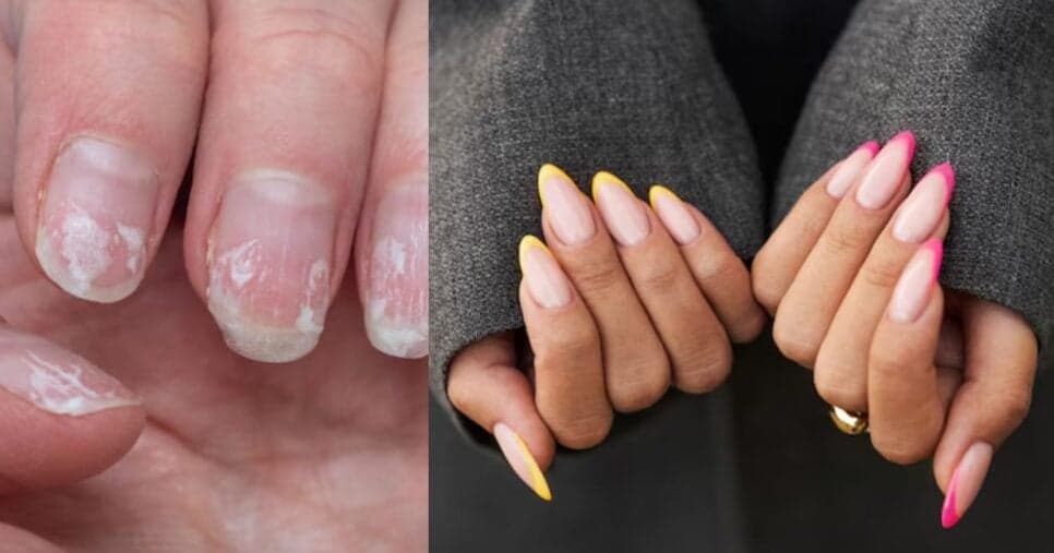 Fim da quebra e gastos com alongamento: Receitinha com 1 ingrediente faz unhas durarem quase eternamente