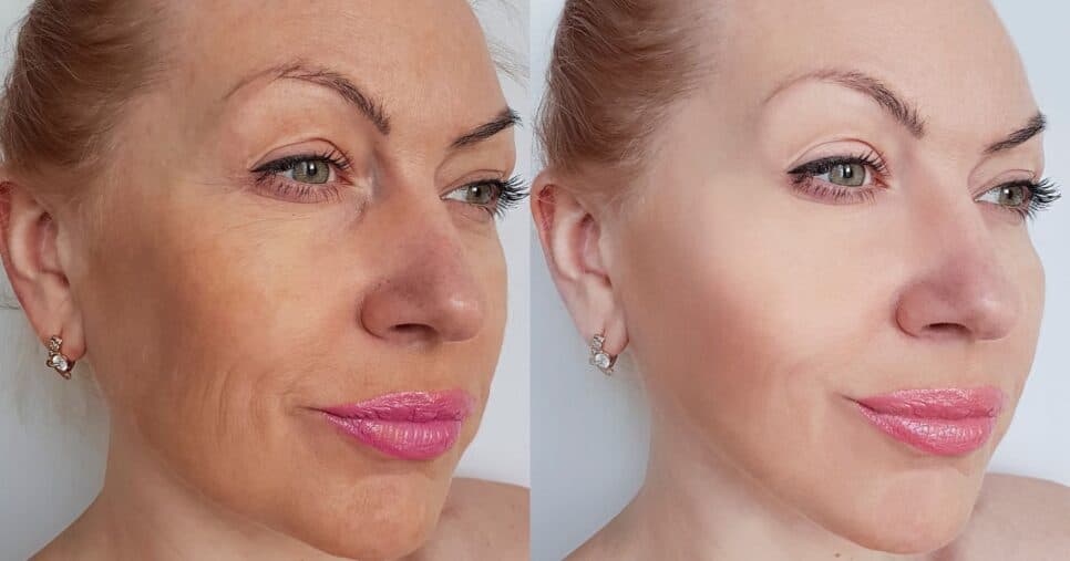 Pele flácida nunca mais: 5 passos infalíveis trazem rejuvenescimento facial as mulheres 40+