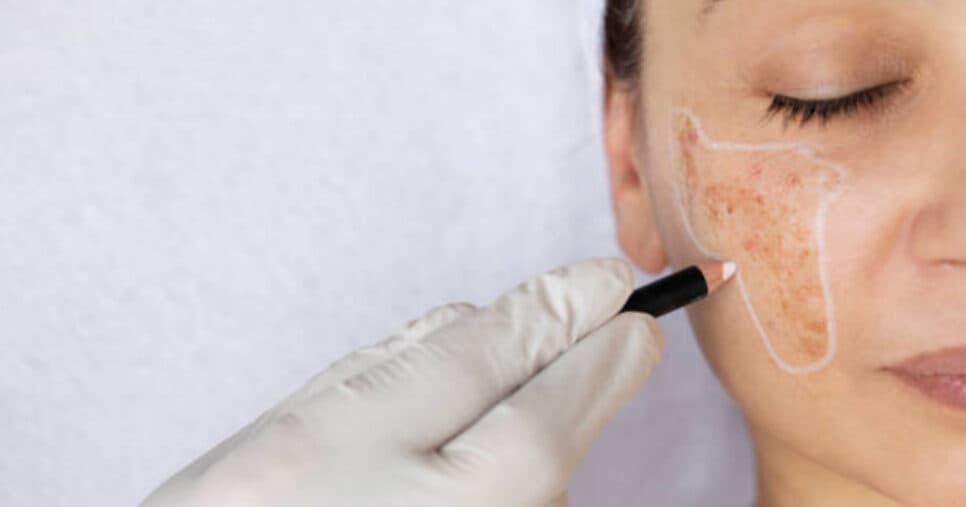 Melasma (Foto: Reprodução/iStock) Melasma (Foto: Reprodução/iStock)
