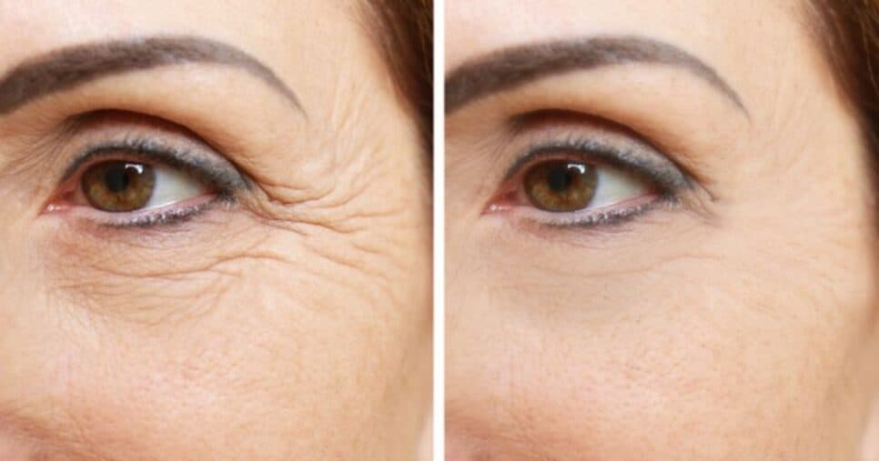 Creme natural arranca rugas de mulheres 40+ - (Foto: Internet) Creme natural arranca rugas de mulheres 40+ - (Foto: Internet)
