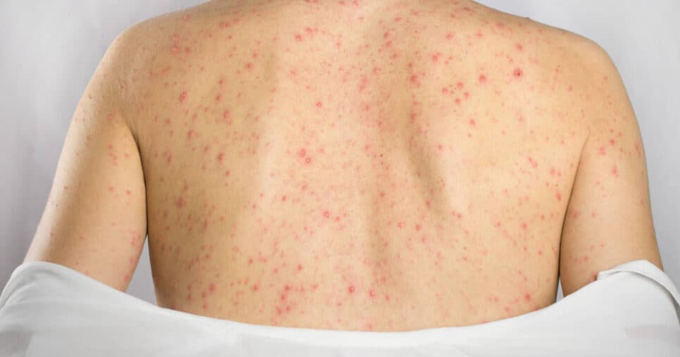 Fim do pesadelo: 5 truques para acabar com as espinhas nas costas