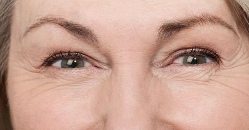 Fim dos pés de galinha: 5 truques para acabar com rugas em casa e rejuvenescer 10 anos