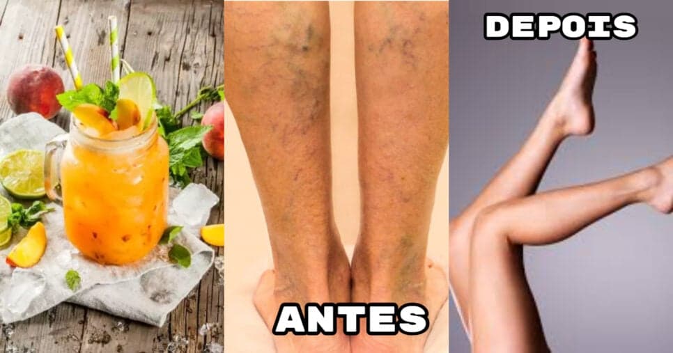 Adeus às varizes: Suco infalível com único ingrediente popular elimina manchas na perna das 40+